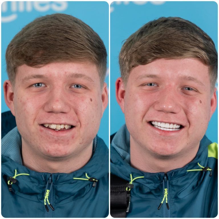 Before and after photos. Man with misaligned teeth smiles, then smiles with straight, white teeth.
