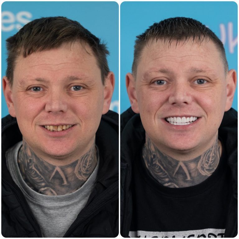 Man's before-and-after teeth. Left: yellowish teeth. Right: bright, white smile. Same man, with neck tattoos.