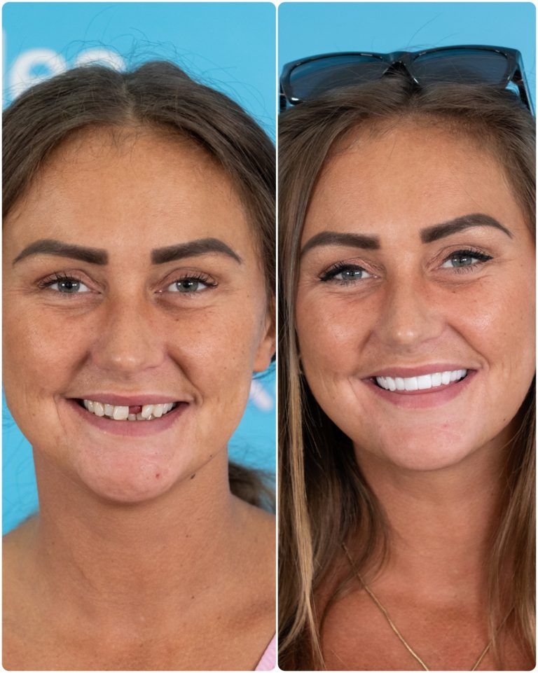Woman with missing front tooth smiling before and after dental work, blue background.