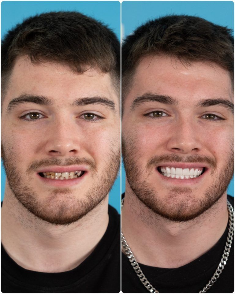 Before-and-after of a man's teeth. Left, uneven and discolored teeth; Right, bright white, straight teeth, smiling.