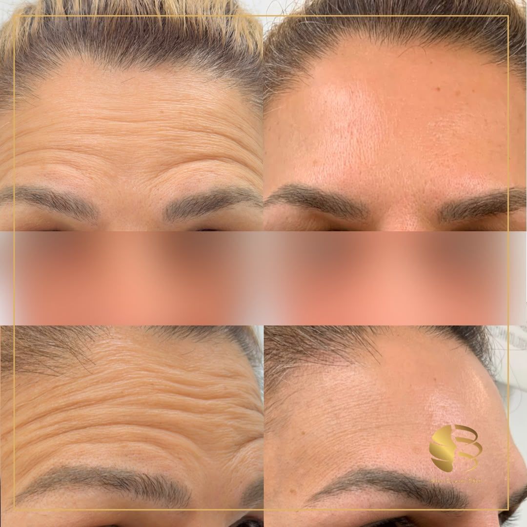 a woman is getting an injection in her face in a beauty salon .