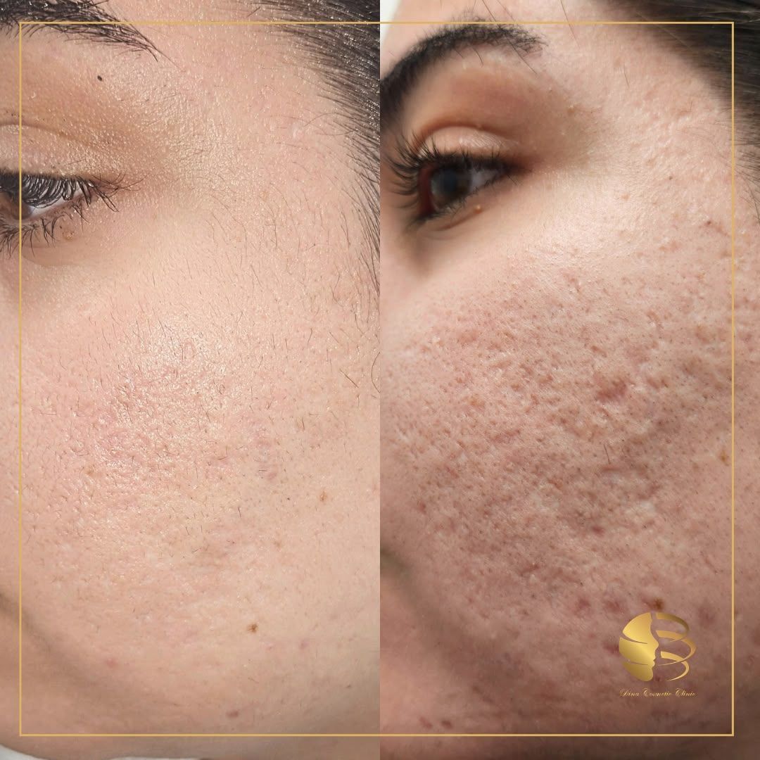 Acne Treatment