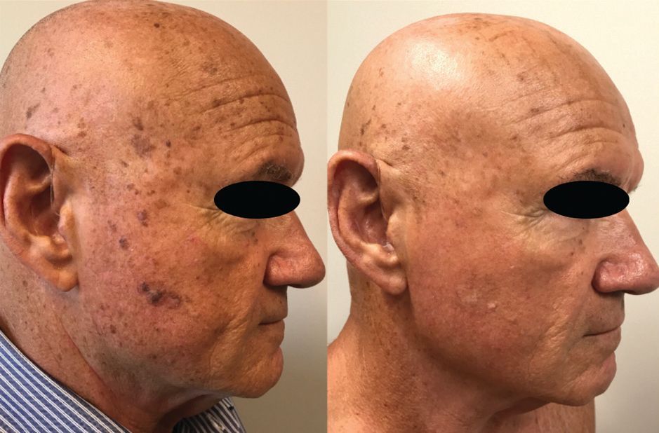 A before and after photo of a bald man 's face.