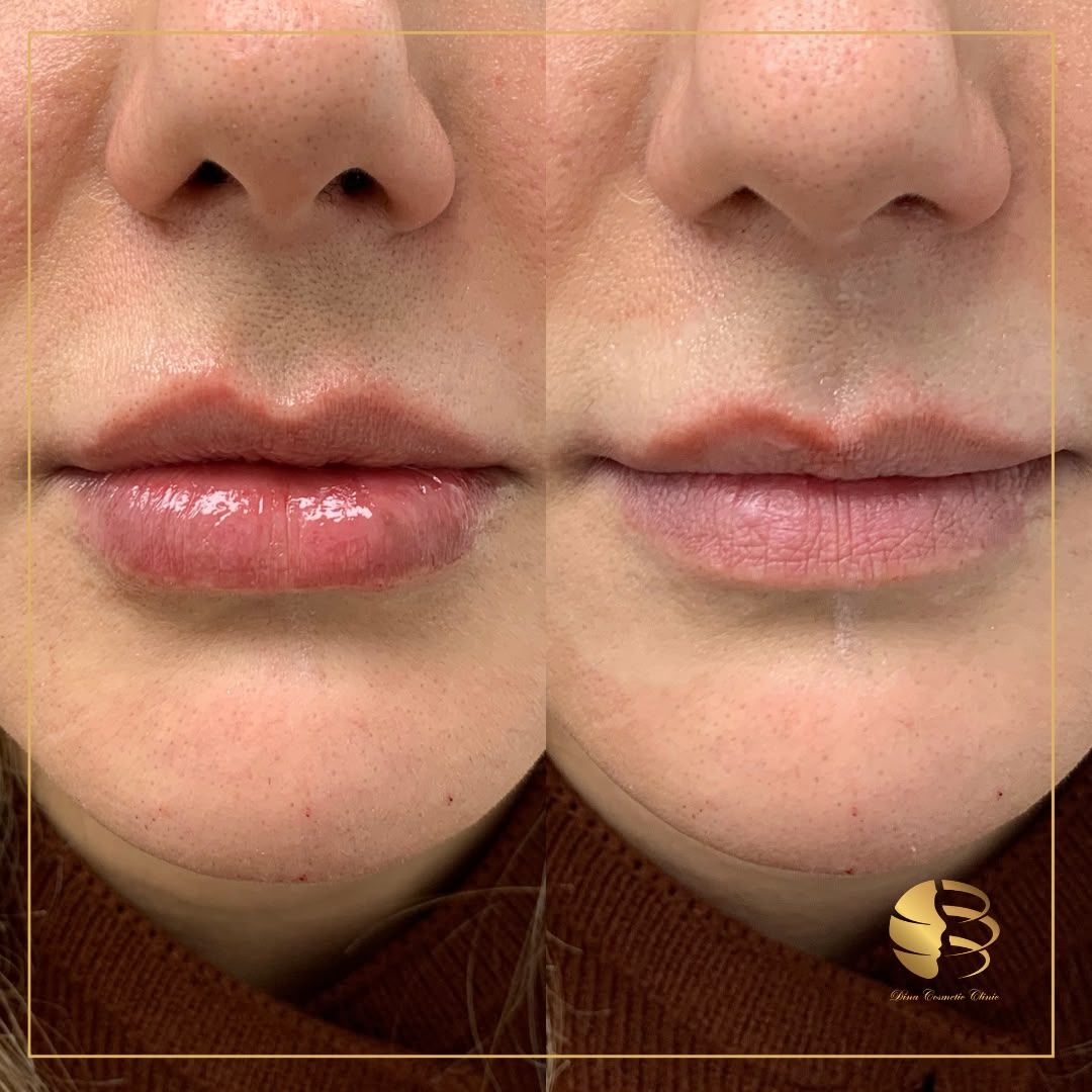 LIp Filler