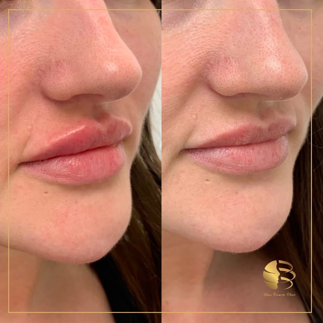 LIp Filler