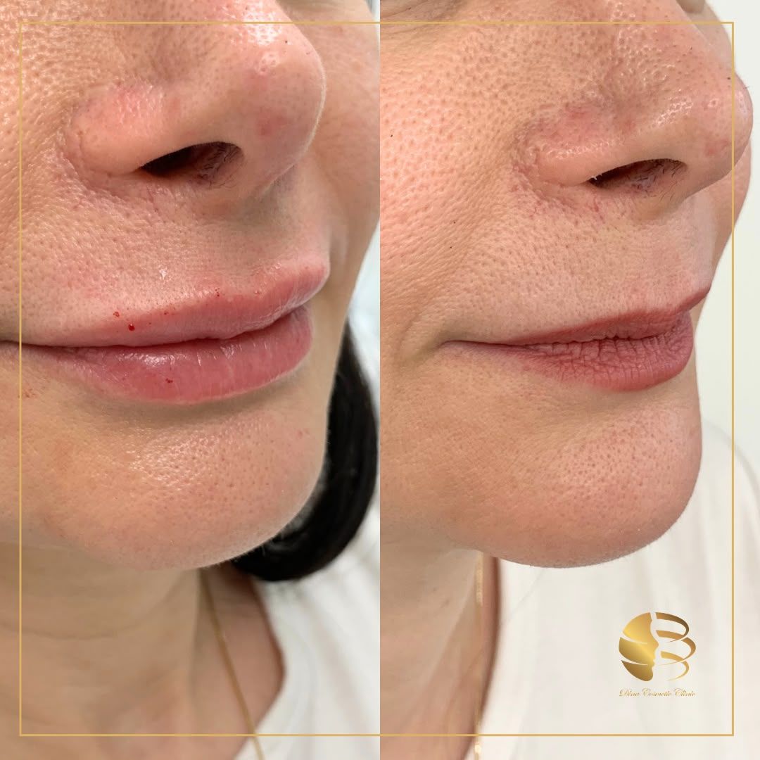 LIp Filler