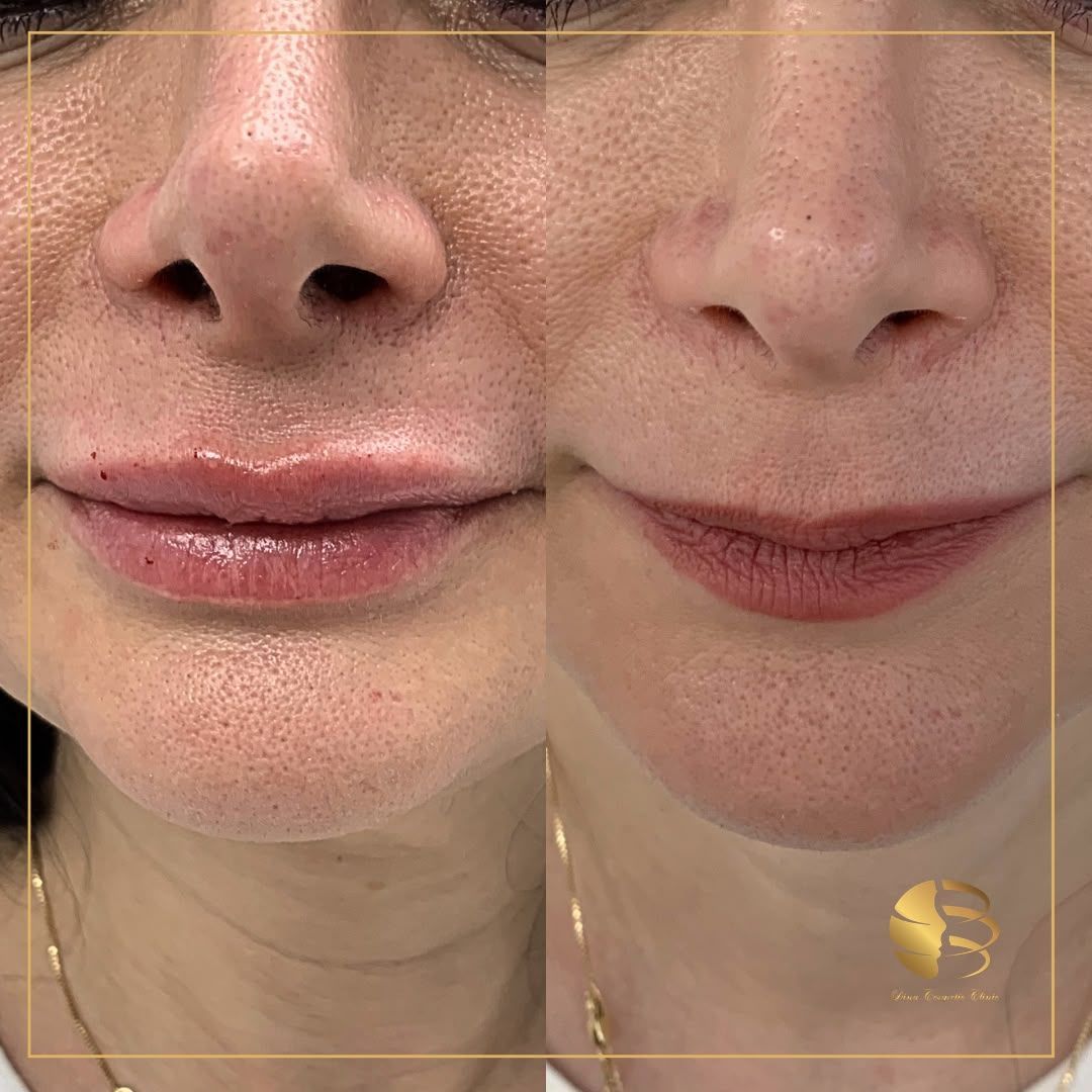 LIp Filler