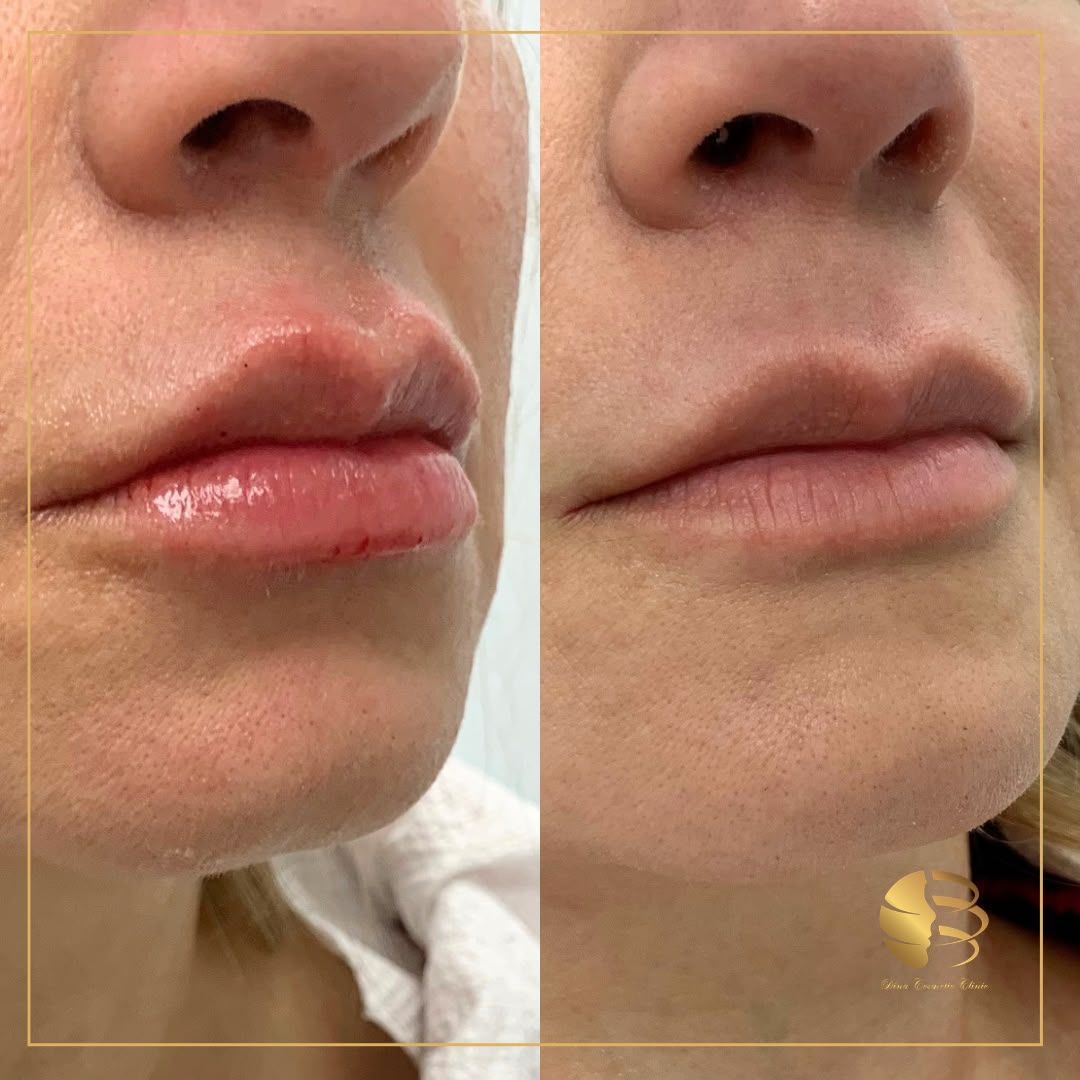 LIp Filler
