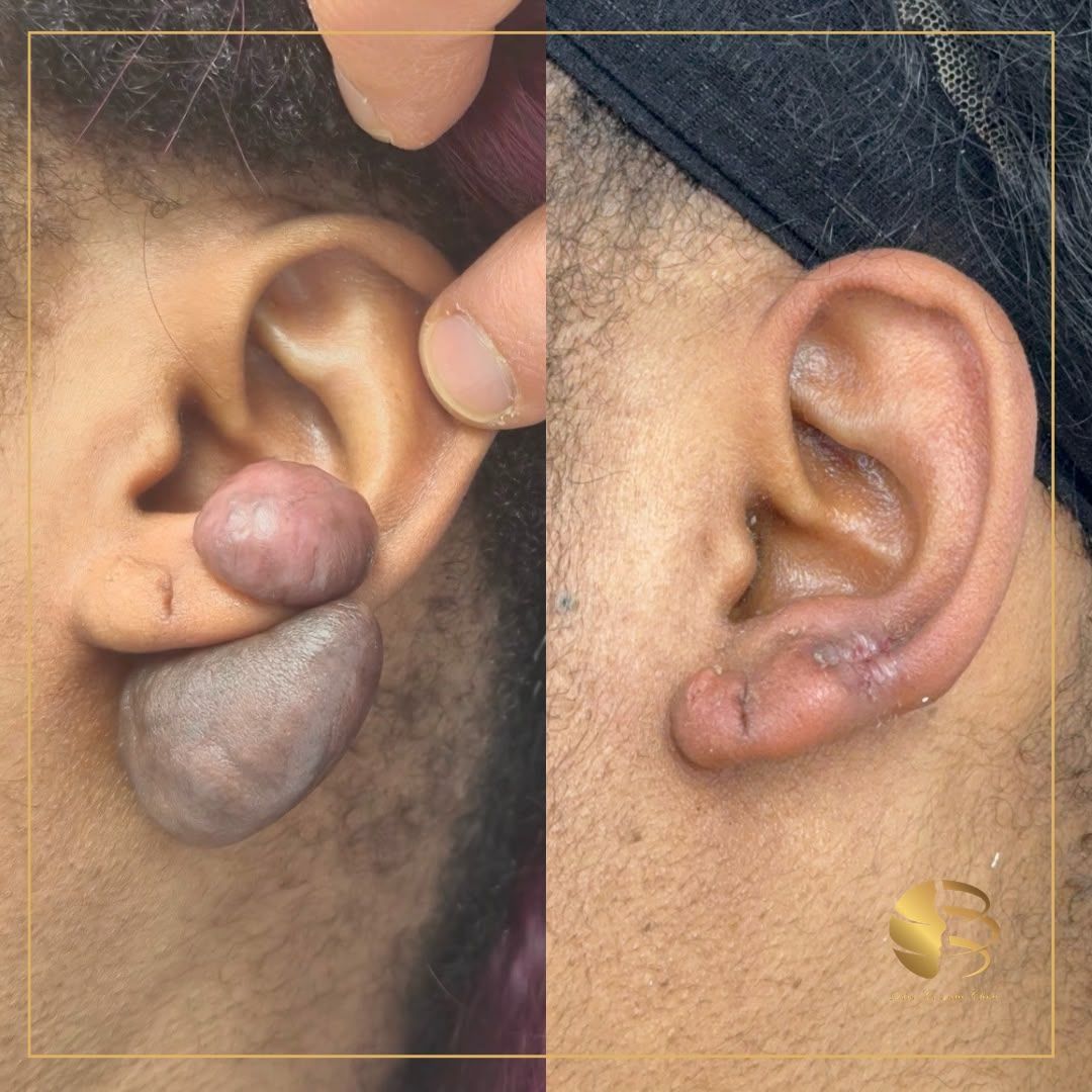 Mole Surgery