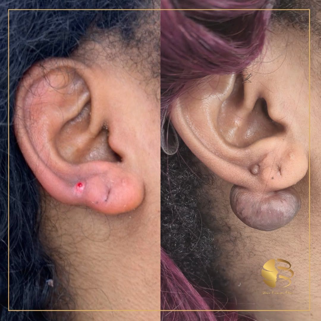 Mole Surgery