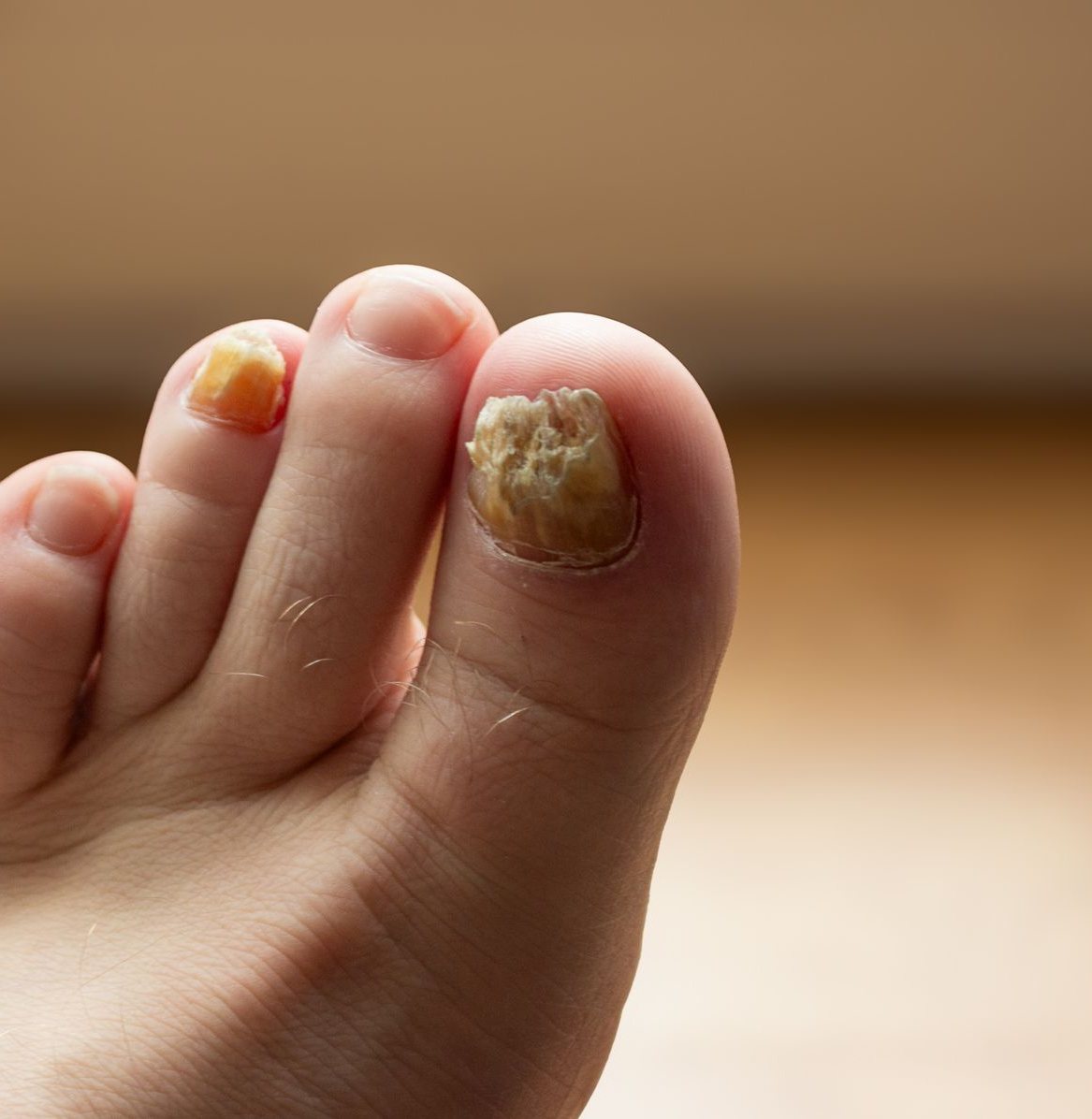 Fungal Toenails