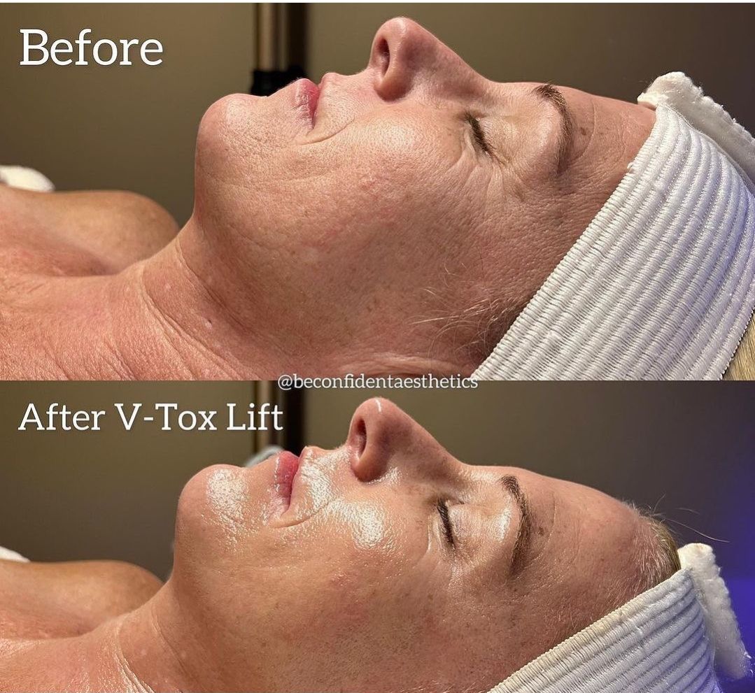 V Tox Lift Before & After