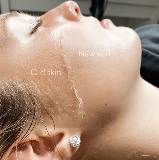 Dermaplaning services offered in Boerne, TX at HAVEN Skincare & Aesthetics