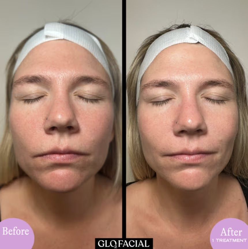 Before & After 1 RF Pro treatment with Glo2Facial