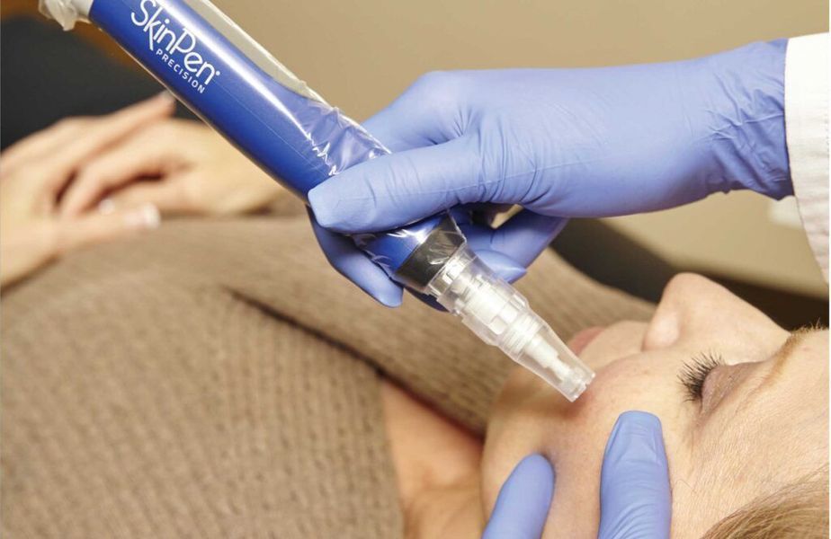 microneedling for acne scars and aging
