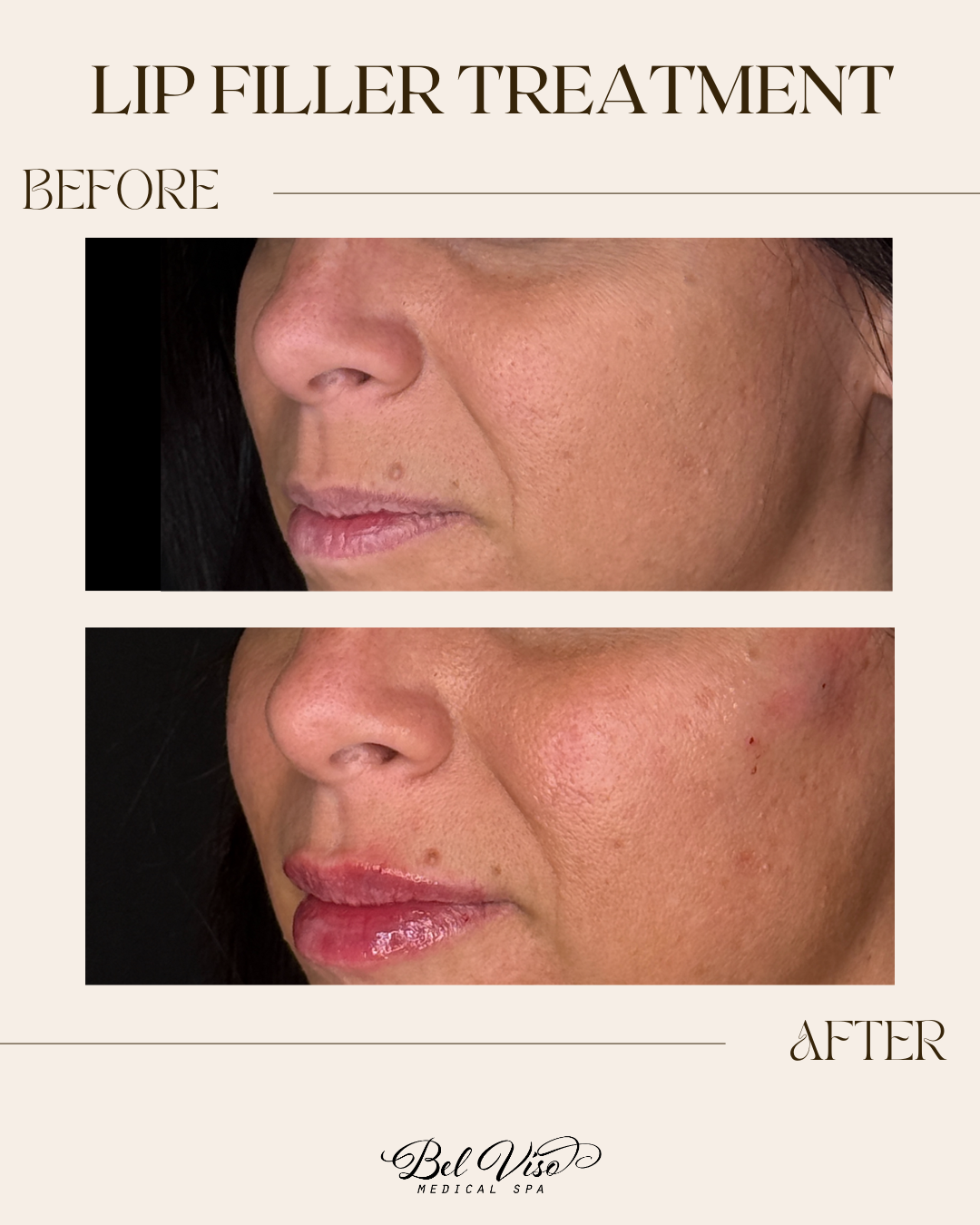 Before-and-after lip filler close-up, showing fuller, glossier lips after treatment.