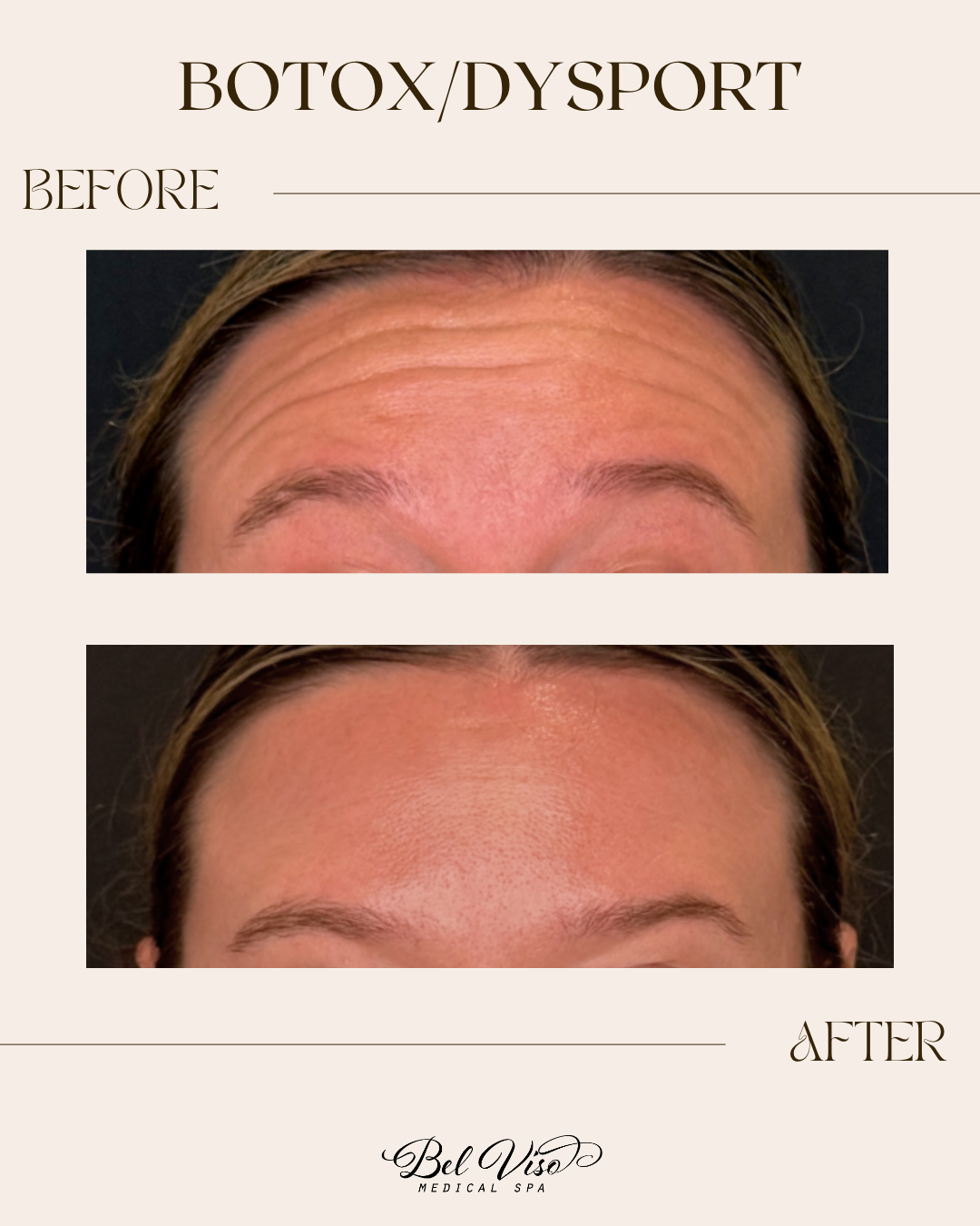 Before-and-after Botox/Dysport forehead photos showing reduced forehead lines and smoother skin.