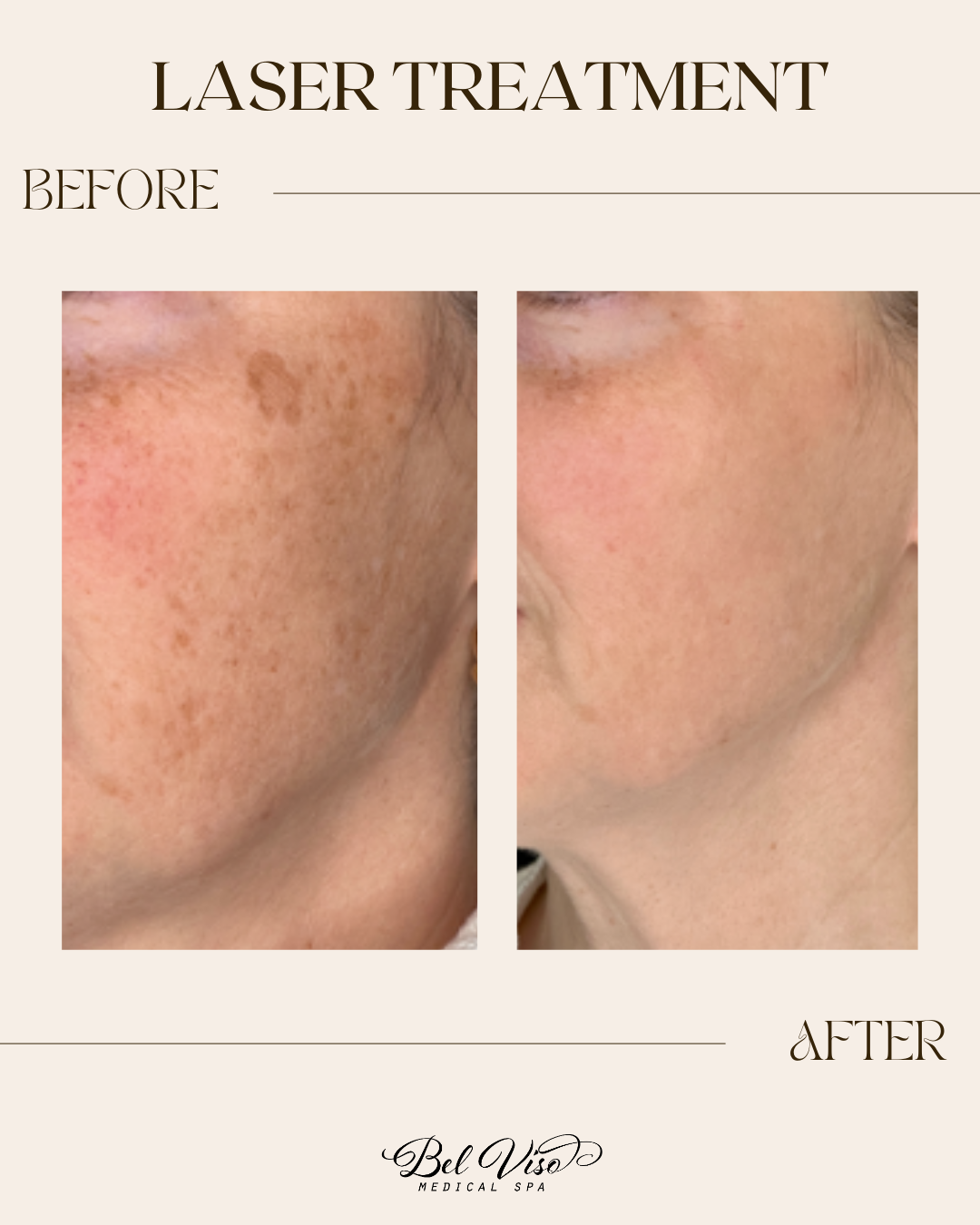 Laser treatment before-and-after skin close-up showing reduced dark spots and smoother complexion.