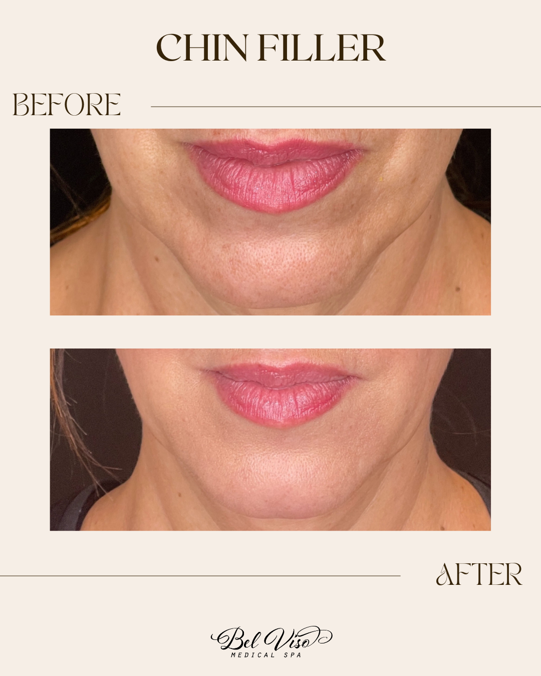 Before-and-after chin filler comparison showing a smoother chin and jawline after treatment.