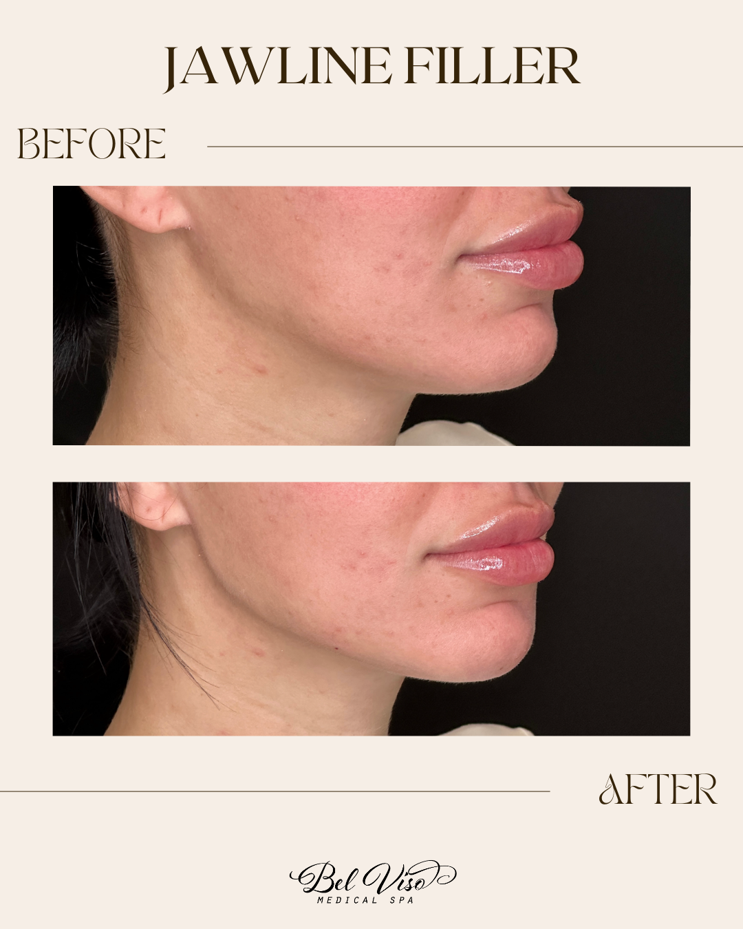 Jawline filler before-and-after side profile showing a more defined chin and jawline.