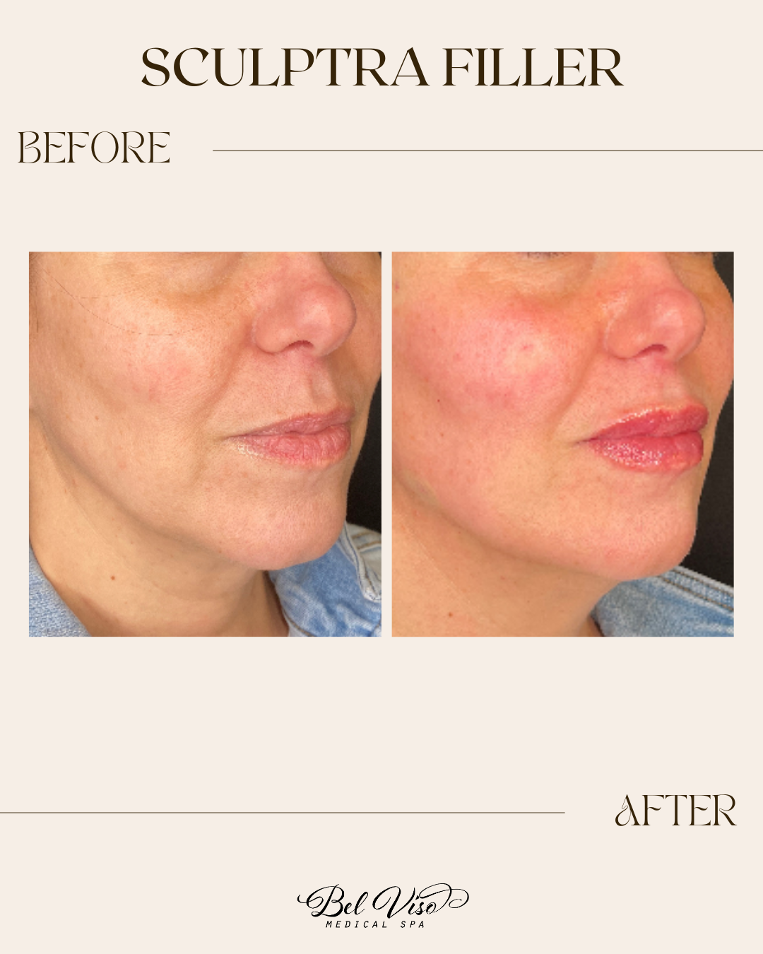 Sculptra filler before-and-after profile photos showing smoother, fuller cheek and lip area.