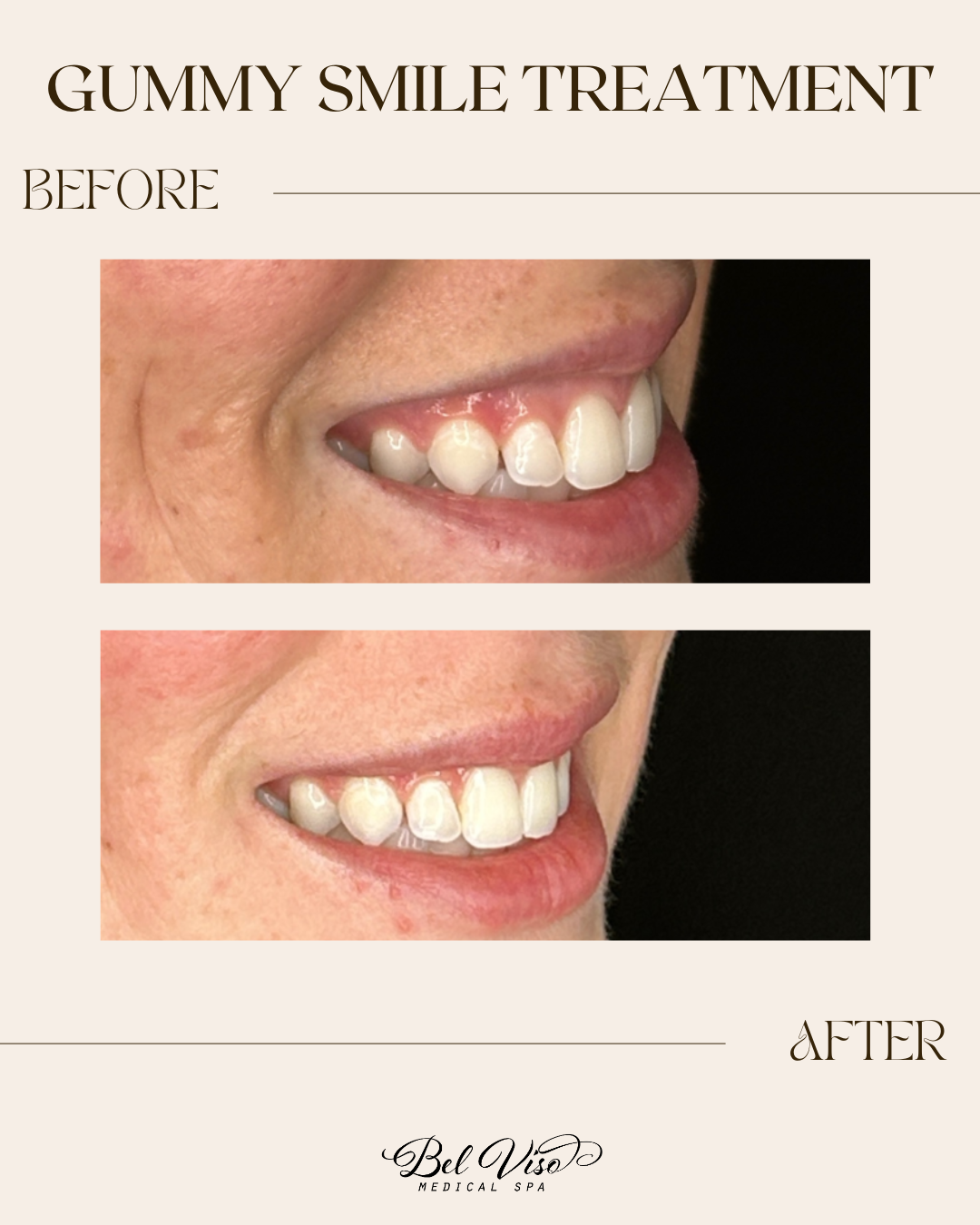 Before-and-after side view of a smiling mouth showing a reduced gummy smile and more even teeth exposure.
