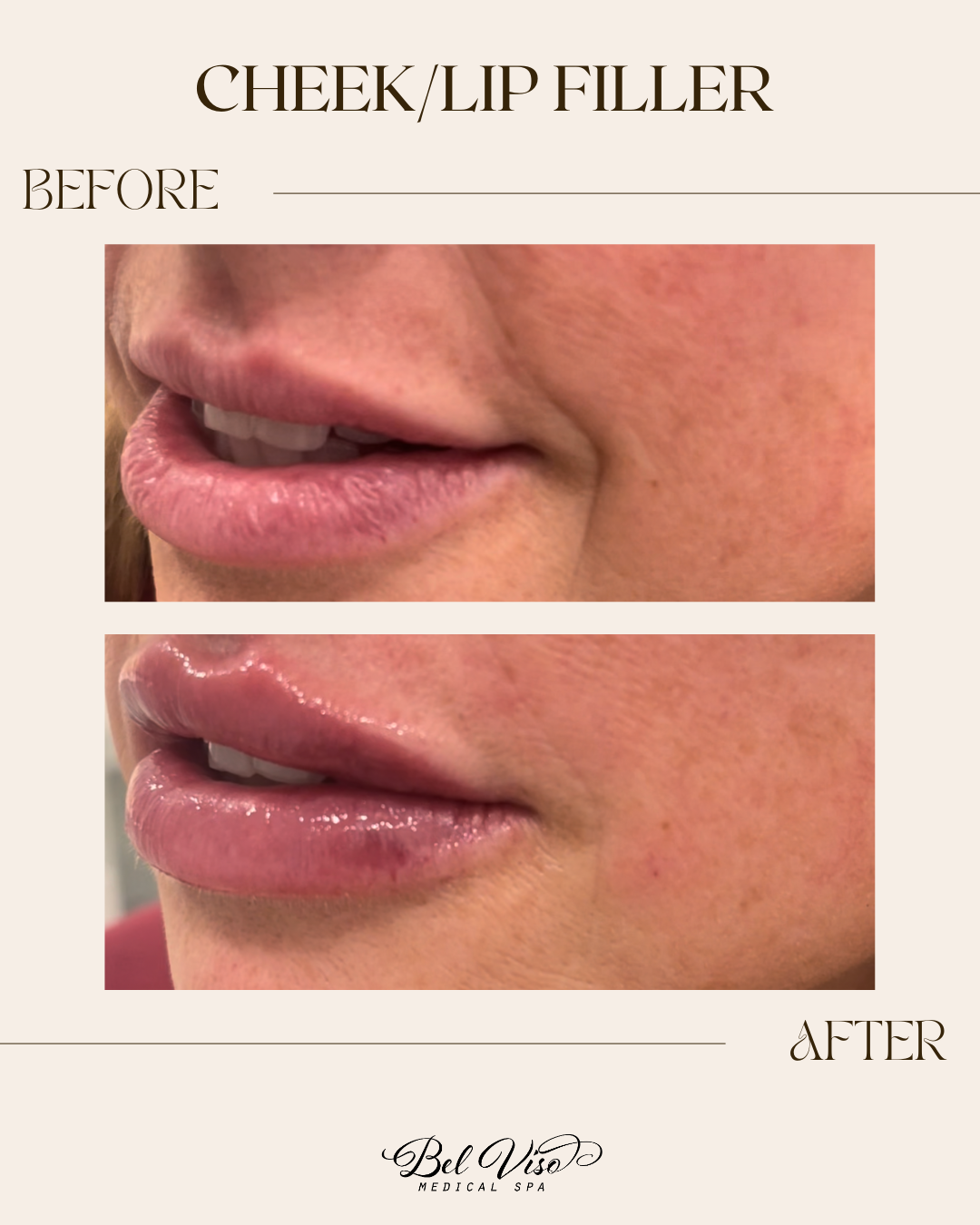 Before-and-after close-up of lips after cheek/lip filler treatment.