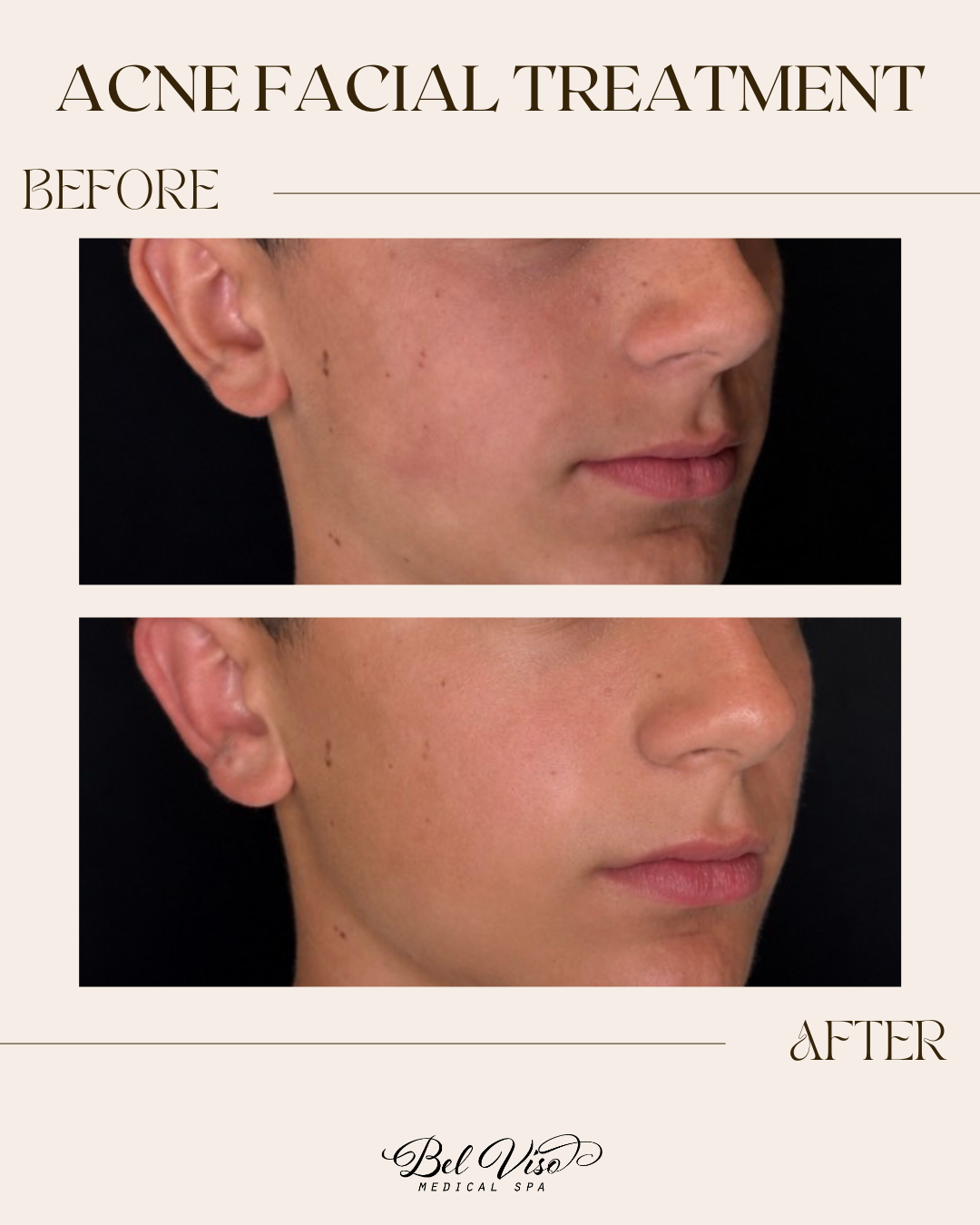 Before-and-after side-profile photos showing improved acne on a man’s cheek and jawline.