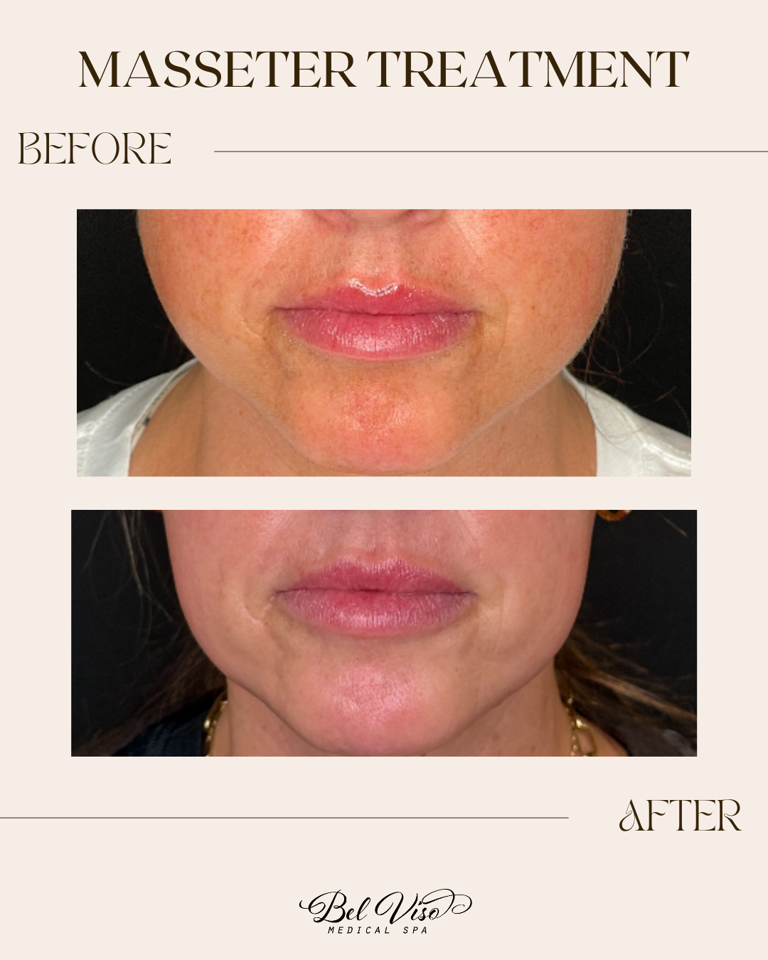 Before-and-after lower-face photos labeled “Masseter Treatment,” showing slimmer jawline after treatment.