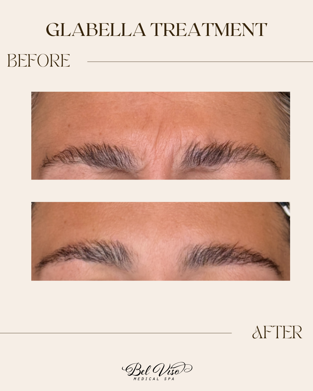 Glabella treatment before and after eyebrow close-ups, showing smoother skin between the brows.