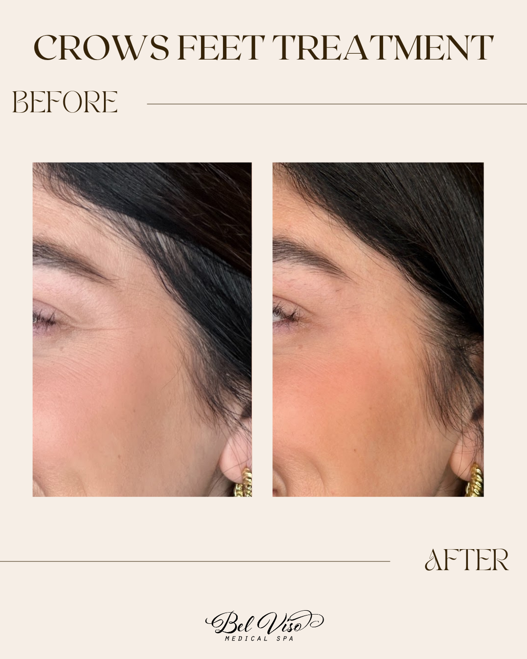 Before-and-after close-up of crow’s feet treatment on a woman’s eye area, showing smoother skin.