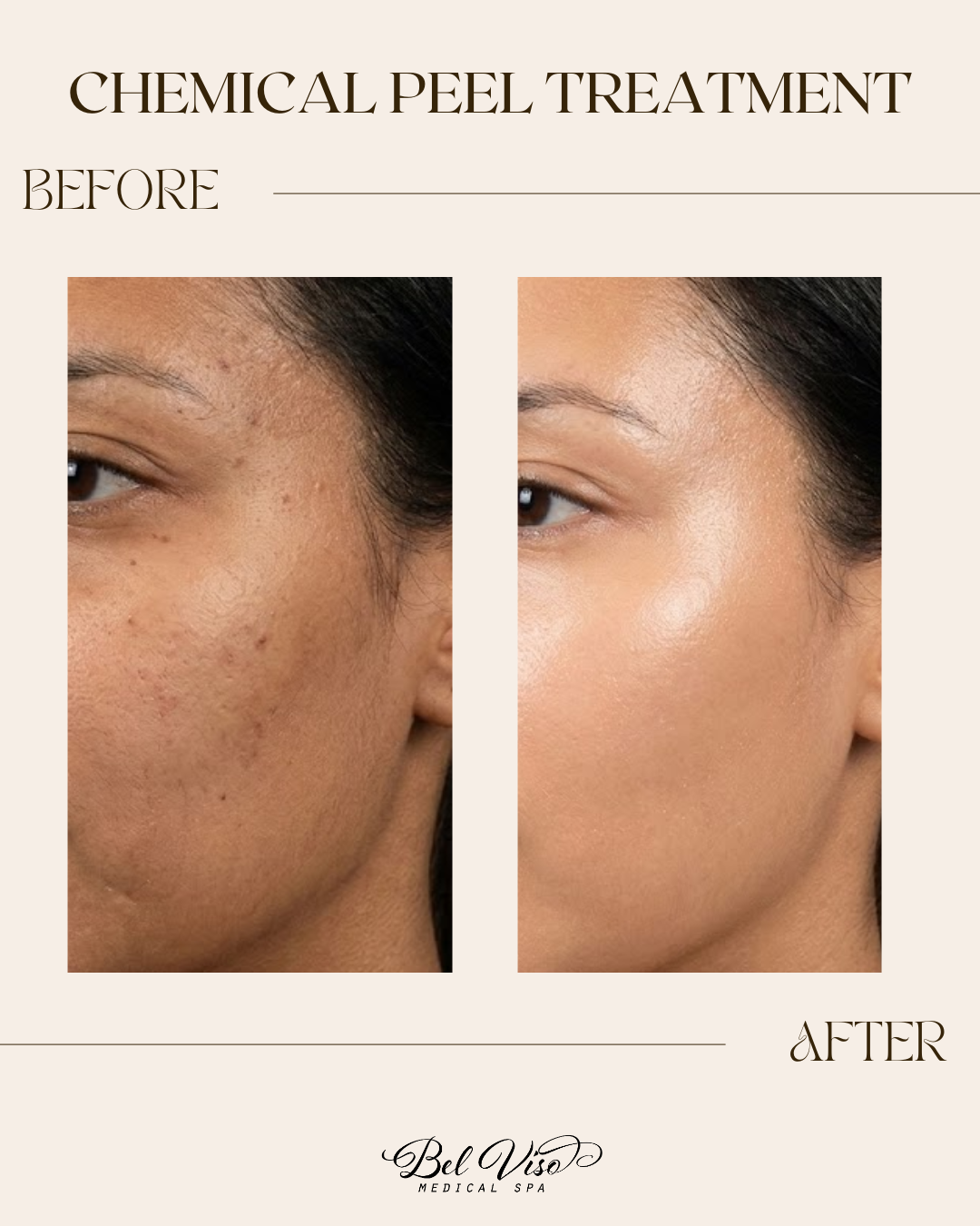 Chemical peel treatment before-and-after close-up of facial skin with reduced dark spots and smoother texture