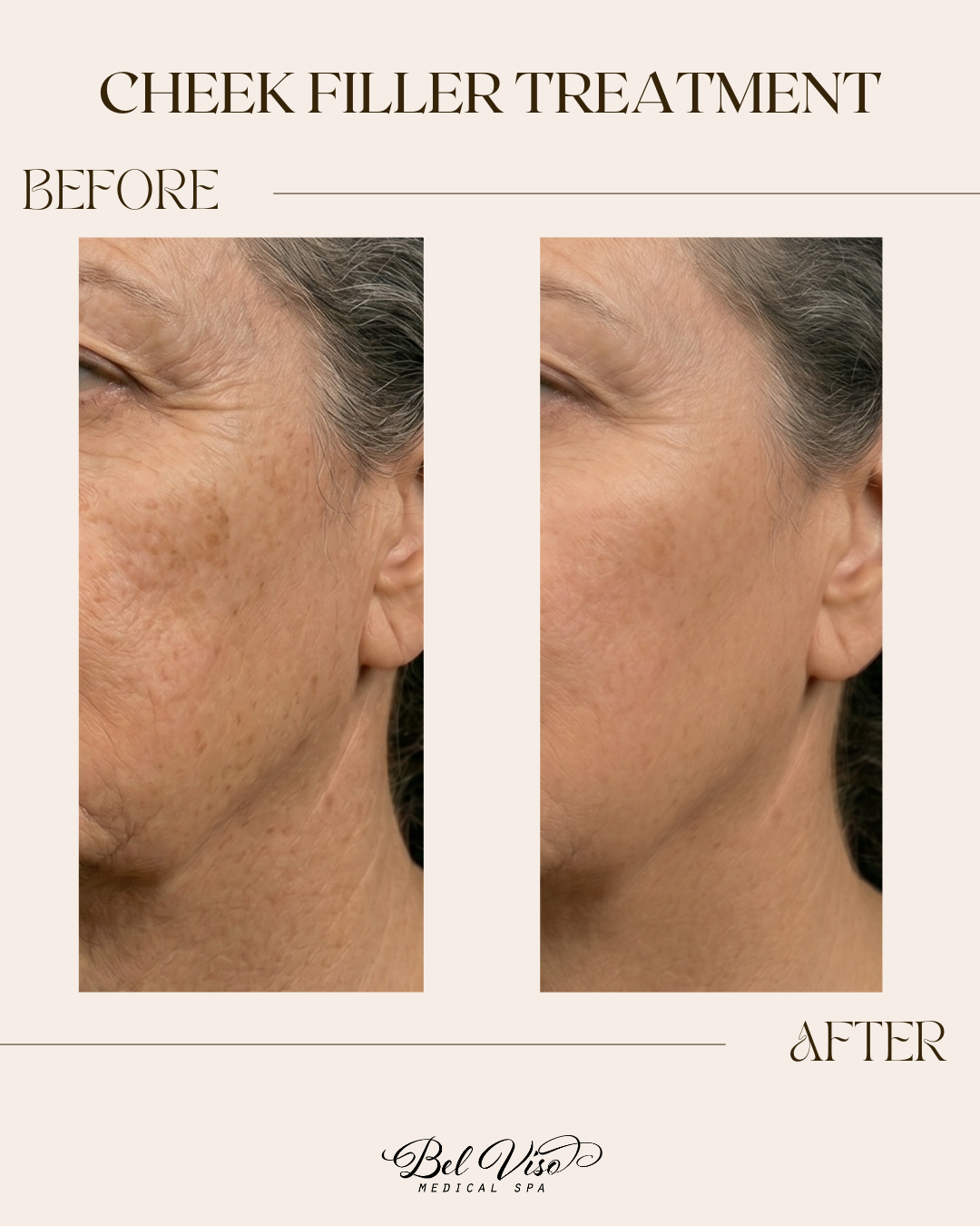 Cheek filler treatment before-and-after close-up of a woman’s face profile