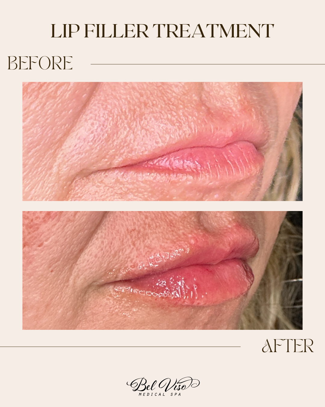 Before-and-after close-up of lips, showing fuller, glossier lips after treatment.