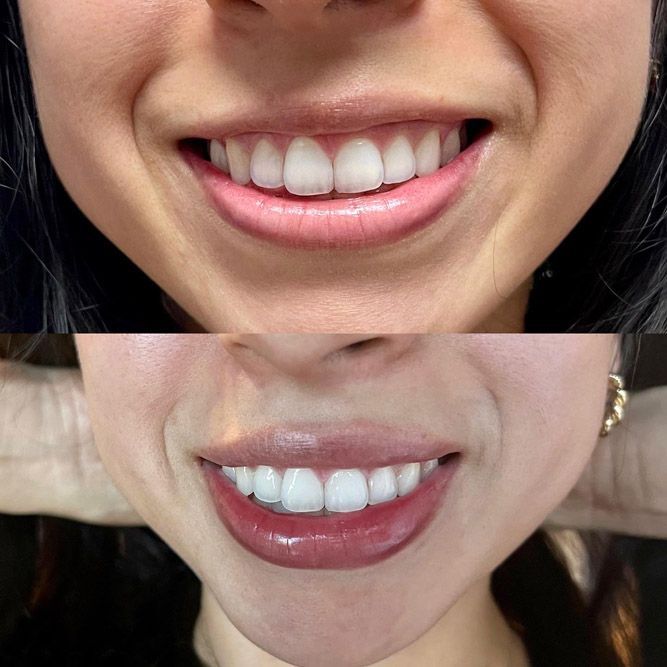 Lip filler before and after Layton Utah