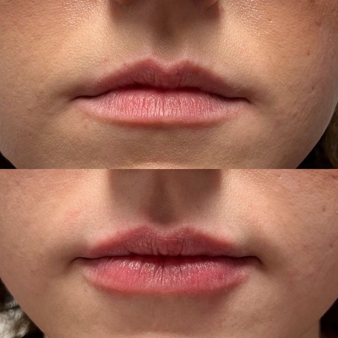 Lip filler before and after Layton Utah natural
