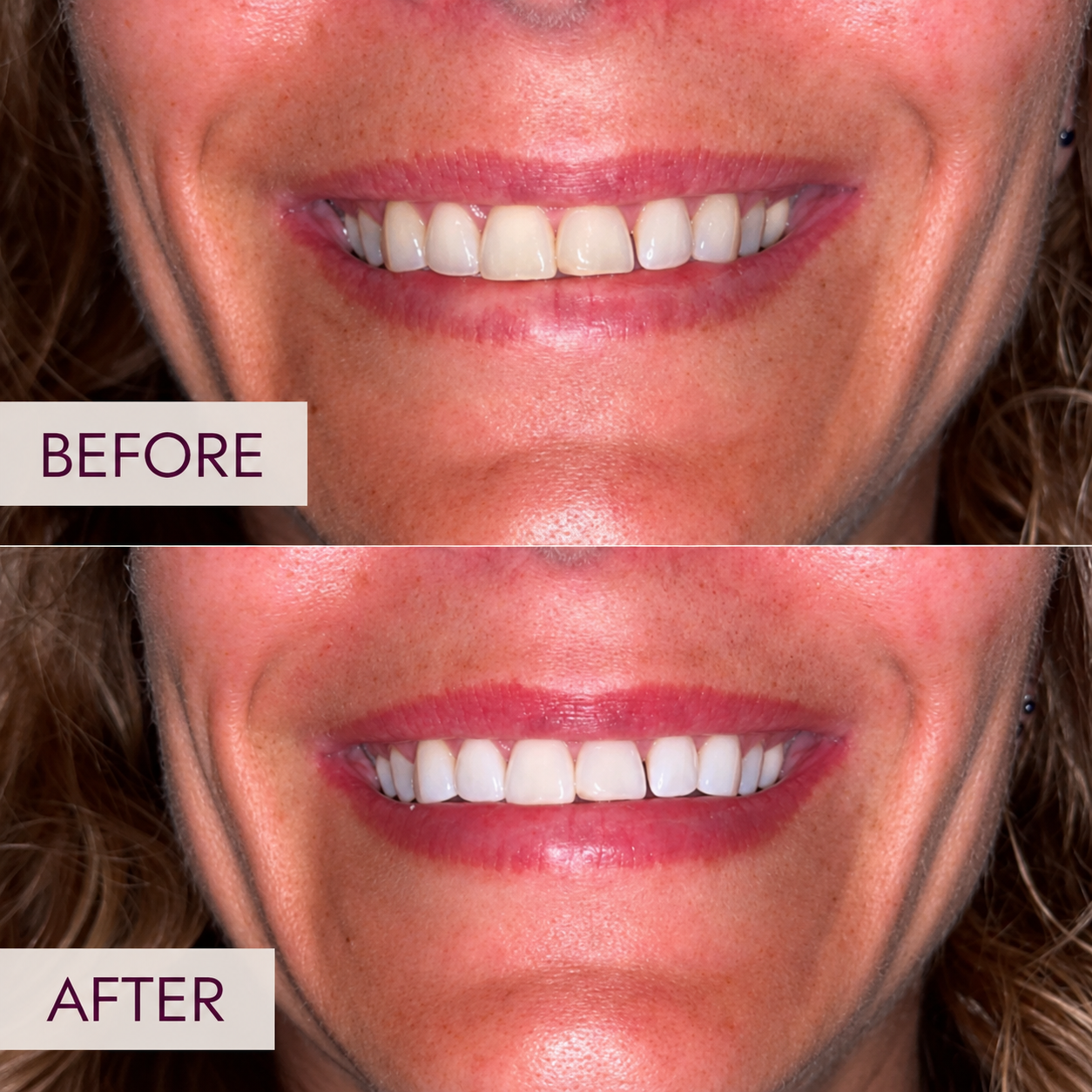 Professional teeth-whitening results showing reduced discoloration at ReJuvU.