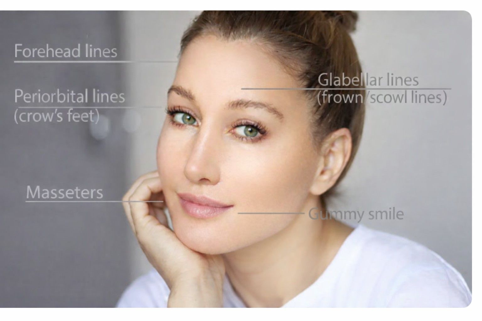 Botox injection treatment areas diagram at ReJuvU Beauty Haven