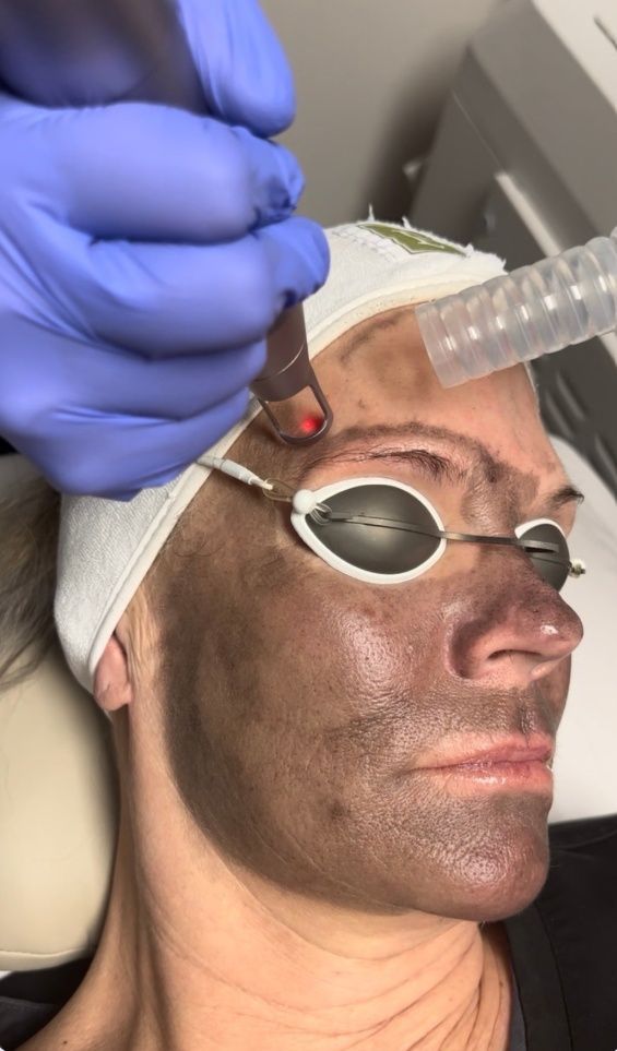 Licensed master esthetician performing a Hollywood Carbon Laser Peel treatment at ReJuvU Beauty Haven in West Point, UT