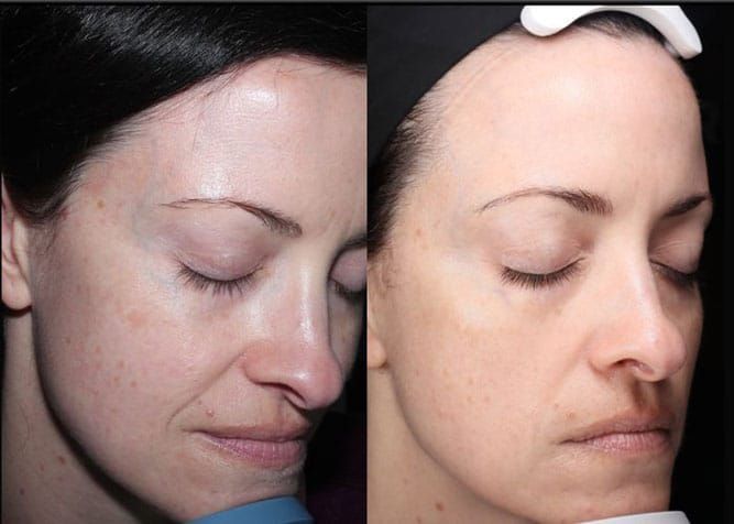 Licensed esthetician applying a professional PCA Skin chemical peel for a patient near Clearfield, UT