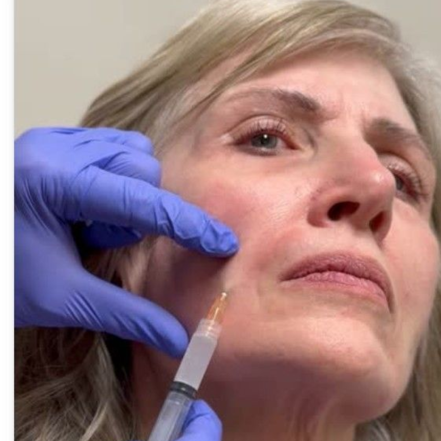 Sculptra injection in cheek to stimulate collagen Clearfield Utah