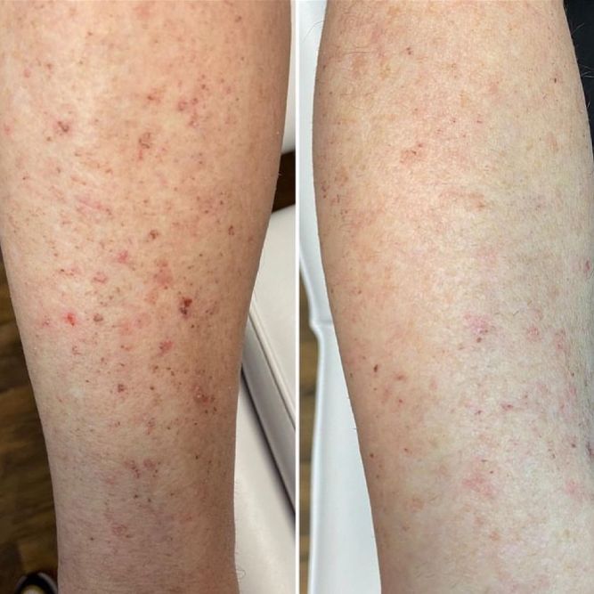 Spectrum IPL laser treatment before and after sun damage clearance on legs near Layton, UT