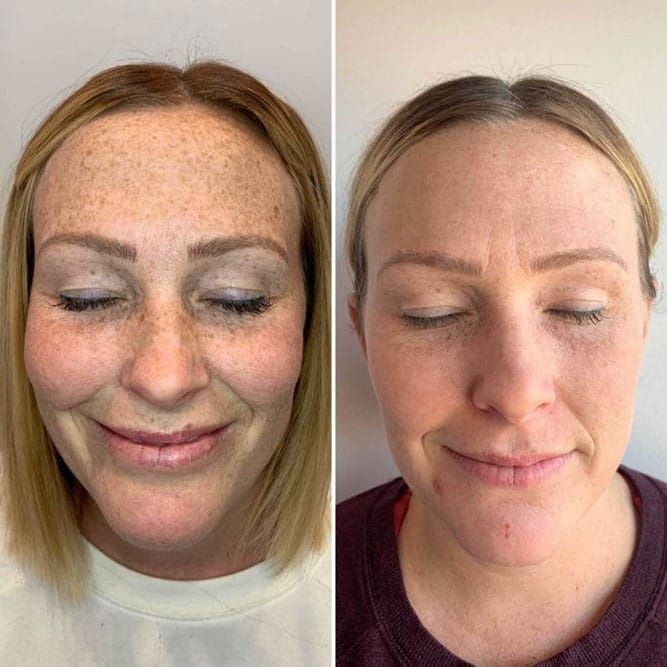 IPL photofacial before and after hyperpigmentation results for a patient near Clearfield, UT