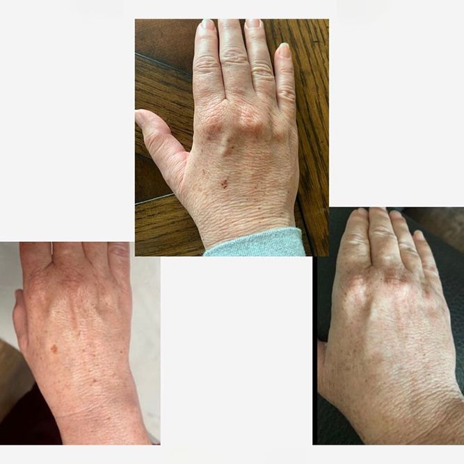IPL photofacial before and after hand age spot removal results near Clinton, UT