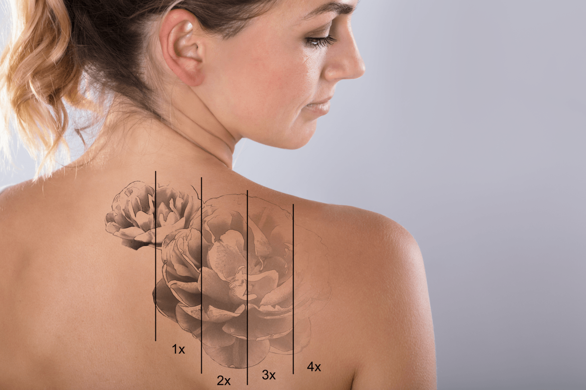 Woman's back with a floral tattoo design and marked sections for treatment.
