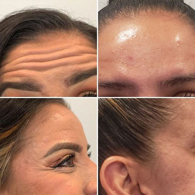Before and after Botox treatment for forehead lines and crow’s feet