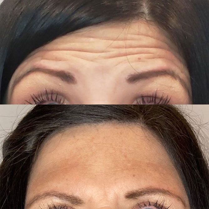 Comparison of a forehead with and without wrinkles after a treatment. Top: Wrinkled. Bottom: Smooth.
