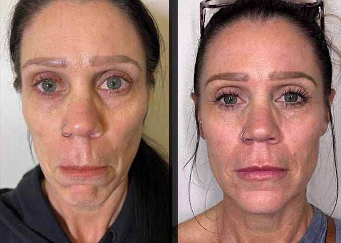 Sculptra before and after