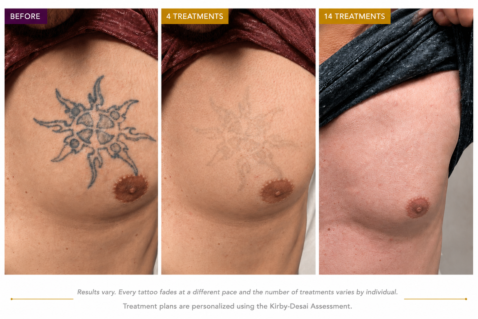 Three-photo progression showing a tattoo fading significantly after four and fourteen laser removal treatments.