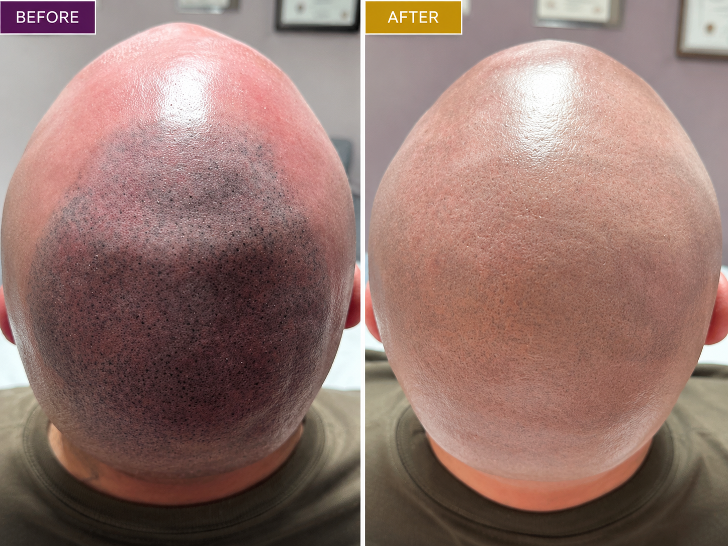 Before-and-after photos showing laser removal of scalp micropigmentation with significant fading of cosmetic scalp pigment.